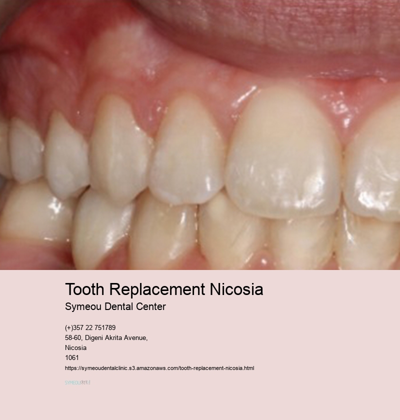 Tooth Replacement Nicosia